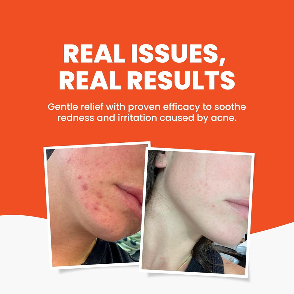 Grahams Natural Acne Face Wash - Soothing & Natural Face Wash For Acne Prone Skin - Fragrance Free Acne Spot Treatment with Aloe Vera, Cucumber & Green Tea Extract - For Sensitive Skin (125ml)