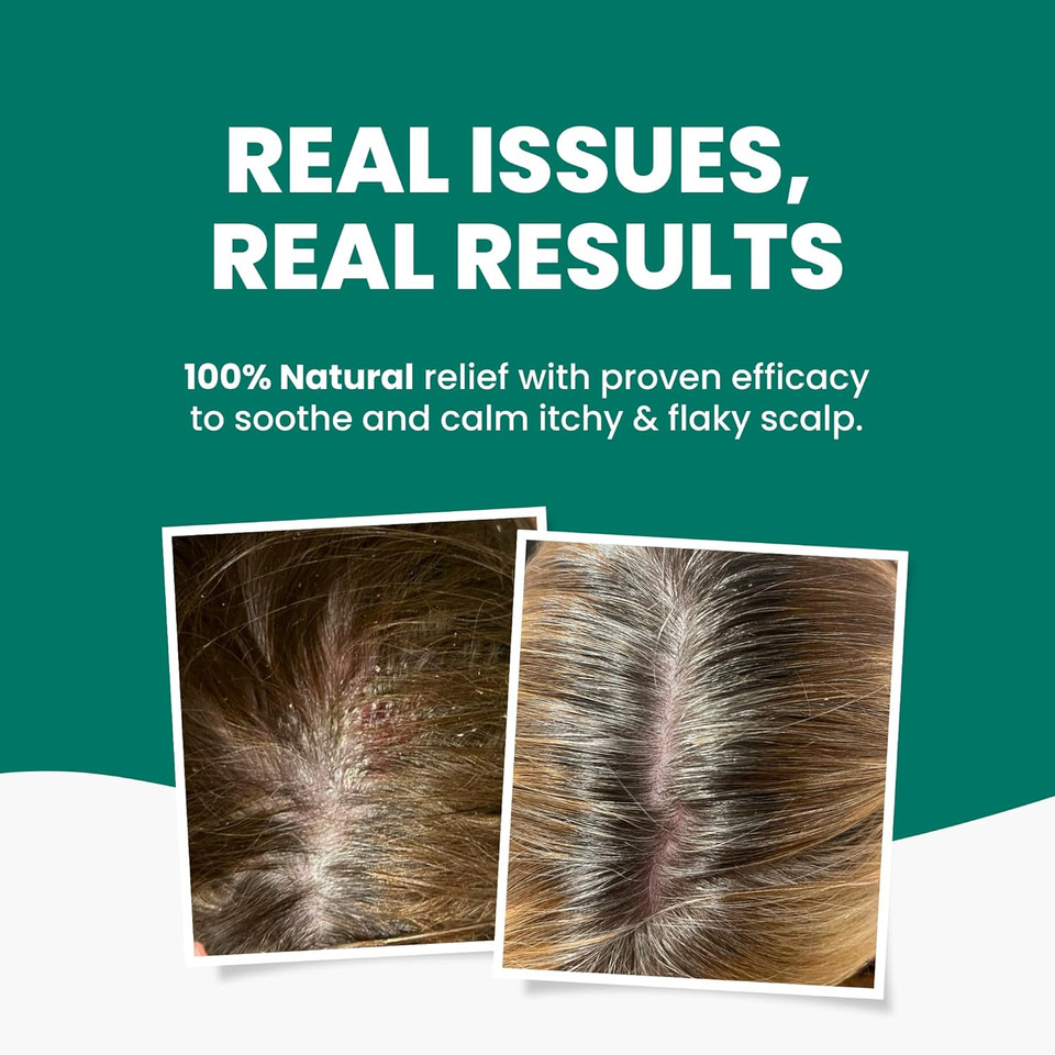 Grahams Natural Scalp Relief Oil - Scalp Treatment For Dry, Itchy & Flaky Scalp Psoriasis, Seborrheic Dermatitis & Dandruff Scalp Treatment - Hydrating, Moisturising & Exfoliating Scalp Oil (100ml)