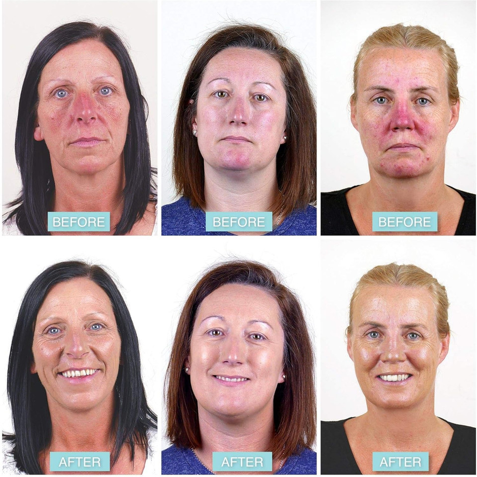 Rosalique 3 in 1 Anti-Redness Miracle Formula Colour Corrector SPF50 for Hypersensitive and Redness Prone Skin, Suitable for All Skin Types 1 x 30 ml