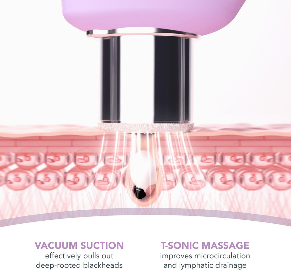 FOREO KIWI Derma Microdermabrasion Machine, Whitehead & Blackhead Remover Tool, Premium Skincare Face Exfoliator & Pore Vacuum, T-Sonic Massage & Resurfacing Face Scrubber Device FOREO KIWI Derma Microdermabrasion Machine, Whitehead & Blackhead Remover Tool, Premium Skincare Face Exfoliator & Pore Vacuum, T-Sonic Massage & Resurfacing Face Scrubber Device