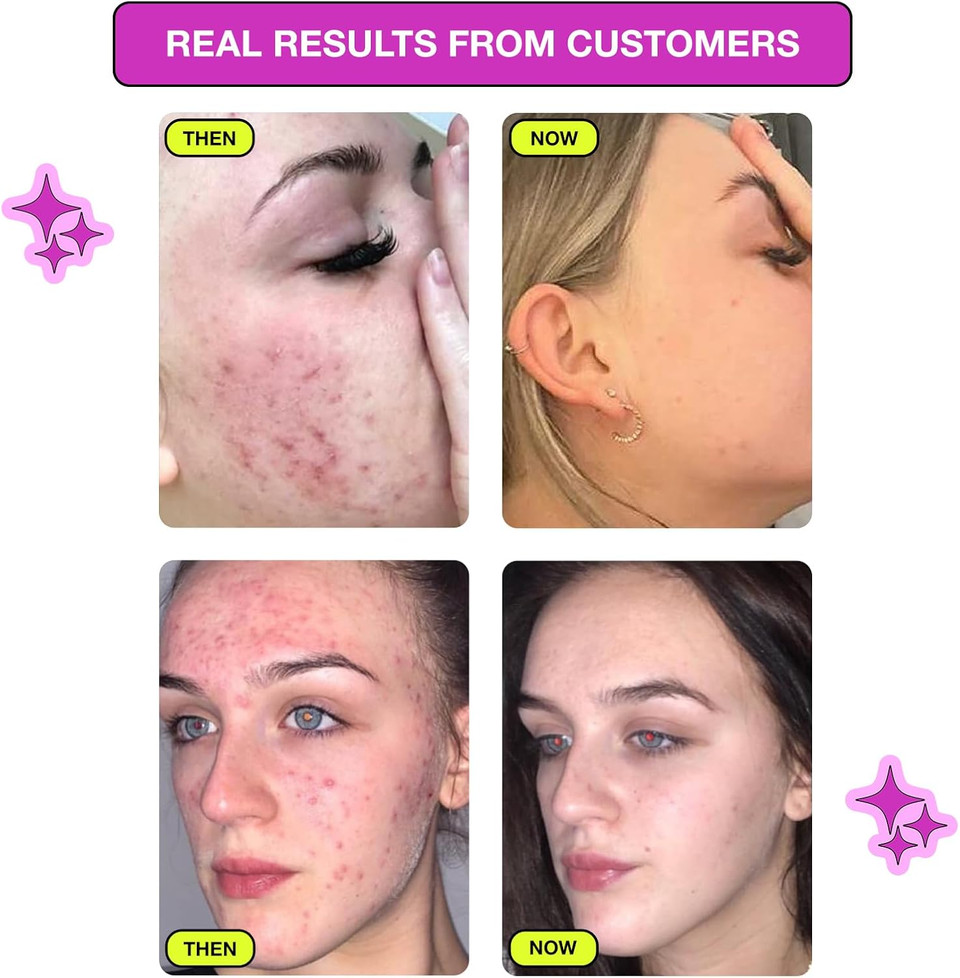 Carbon Theory 20% Niacinamide Serum - Pore Minimizer & Blackhead Remover - Balances & Evens Skin Tone - 1% Zinc Serum - Vegan Spot Treatment - VaPOREize, 30ml