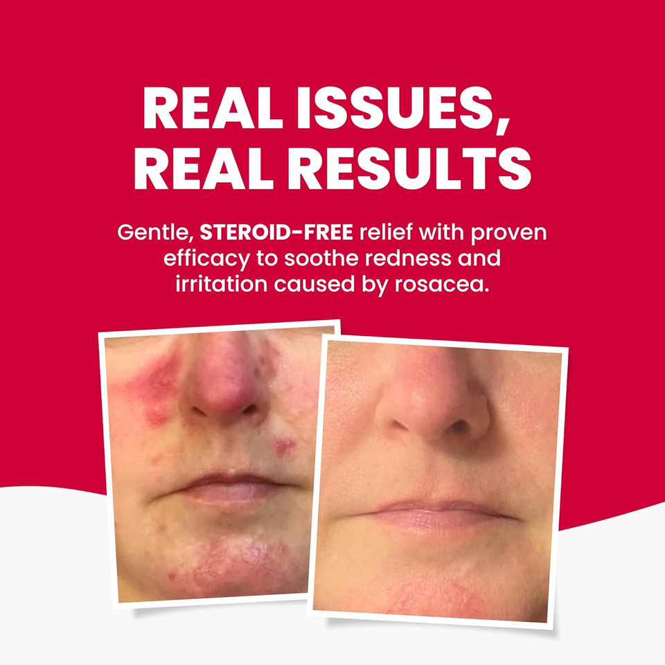 Grahams Natural Rosacea Cream - Clinically Proven Anti-Redness Treatment for Face to Soothe, Moisturise, Hydrate & Calm Sensitive Rosacea-Prone Skin | Hypoallergenic, Steroid-Free (75g)