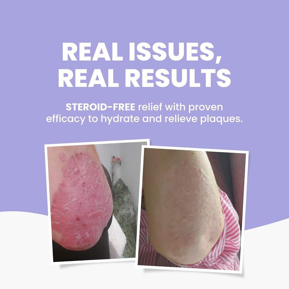 Grahams Natural Moisturising Psoriasis Cream - Clinically Proven Psoriasis Treatment for Scale, Dry Skin & Itchiness on Skin, Face & Scalp - With Calendula, Manuka Honey & Urea | Steroid-Free (75g)