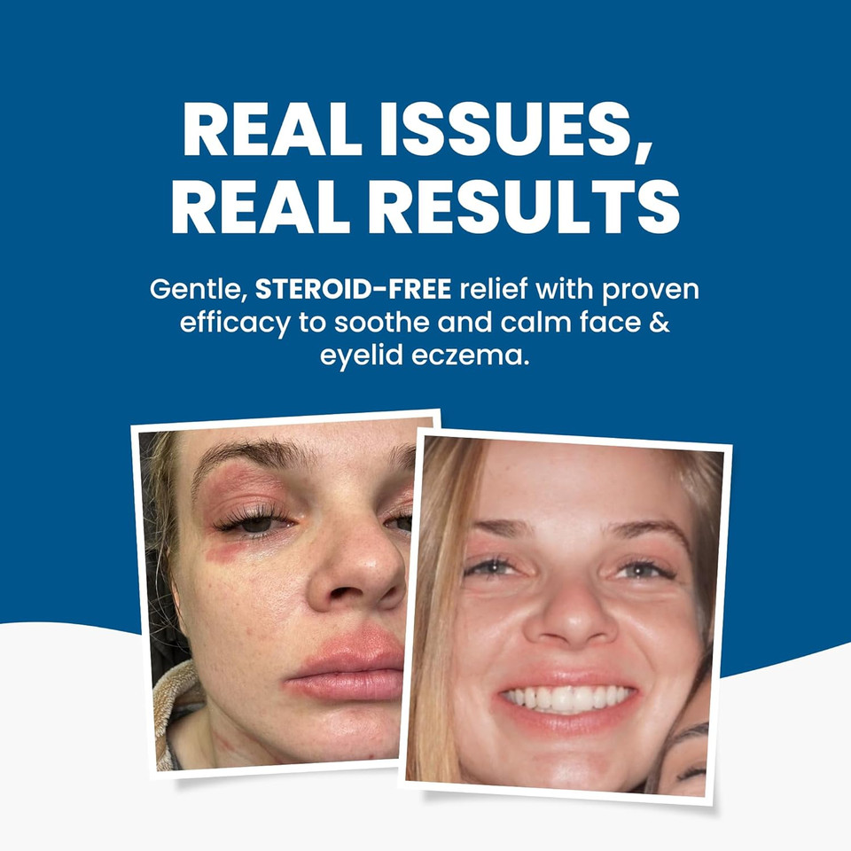 Grahams Natural Face & Eyelid Relief Pack  Clinically Proven Eczema Face Cream (50g) + Eyelid Oil (50ml)  Soothing Treatment for Dry, Itchy Skin, & Dermatitis | Steroid-Free for Sensitive Skin