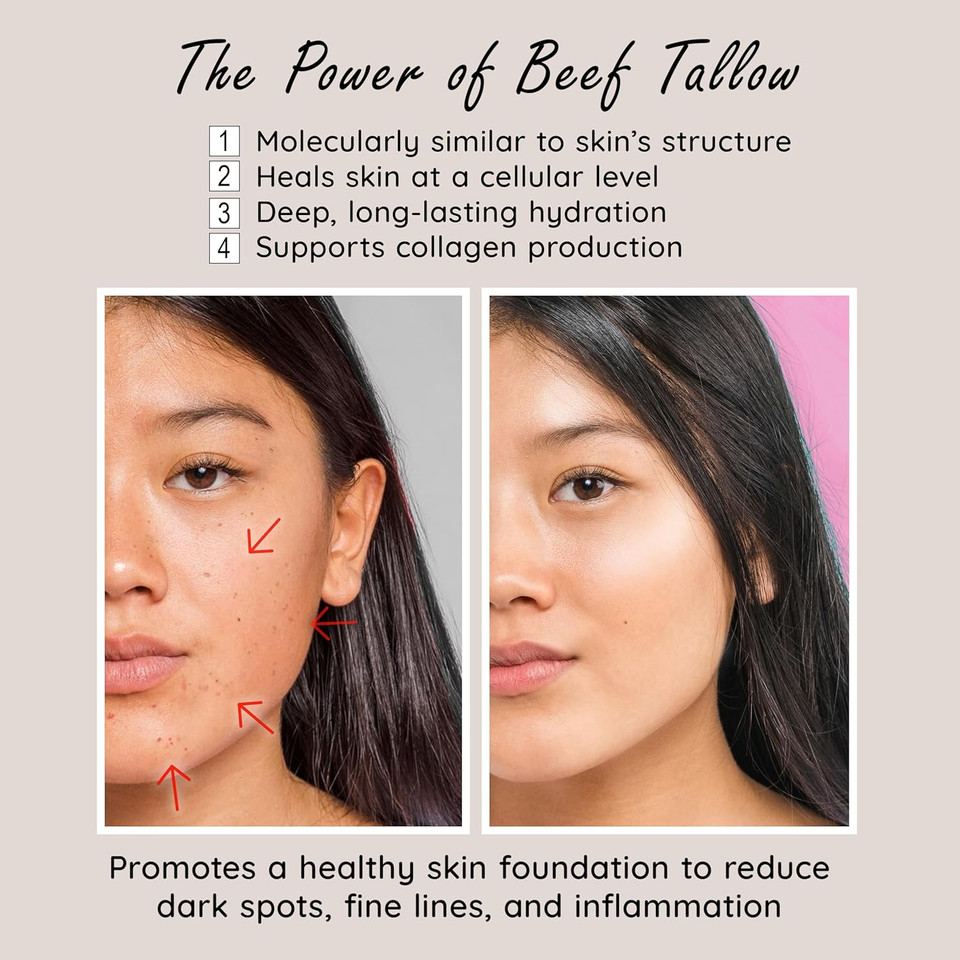 Whipped Milky Beef Tallow For Skin & Face | Made In Usa | 100% Grass-Fed With All-Natural Organic Oils, Dewy Finish Beef Tallow Balm Moisturizer - For Sensitive Acne-Prone Skin, Tea Tree 2Oz