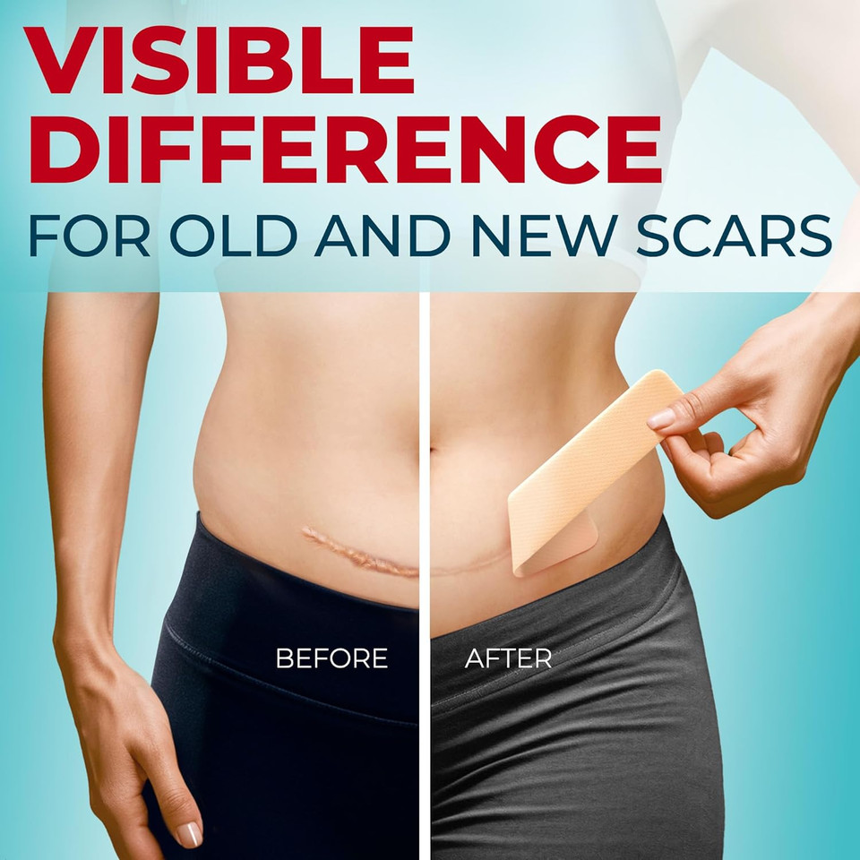Medical Grade Silicone Scar Tape - 1.6X60 - Visible Difference On Surgical & Keloid Scars - Reusable Silicone Scar Sheets - Easy To Use Silicone Tape For Scars