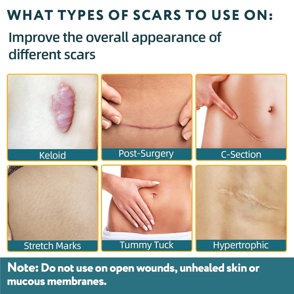 Silicone Scar Sheets, Silicone Scar Tape For Surgical Scars - 60" X 1.6" Roll - 1.5M, Medical Grade Reusable Effective Scar Removal For Keloid, C-Section, Tummy Tuck, And Acne
