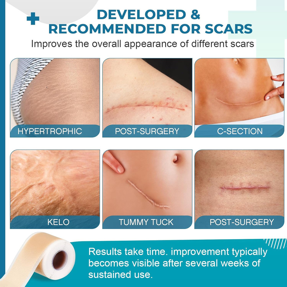 Silicone Scar Sheets, Silicone Scar Tape(1.6X 60 Roll-1.5M), Silicone Scar Strips, Professional Scar Removal Sheets For Surgical Scars, Keloid, C-Section, Burn Et