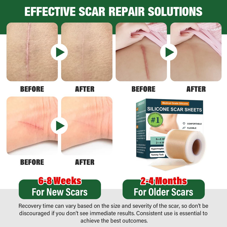 Silicone Scar Sheets,Silicone Scar Tape,Silicone Sheets For Scars,Scar Tape For Surgical Scars,Keloid Bump Removal,Scar Removal For Surgical(1.6"X 120" Roll-3M)