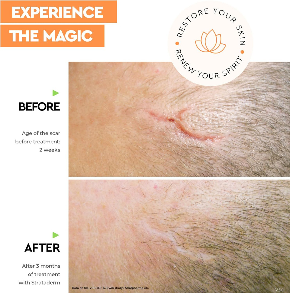 Strataderm Professional Scar Therapy Gel | Old And New Scars From General Surgery, Trauma, Wounds, Burns, Bites, Acne & Skin Disease | Reduces Redness, Discoloration, Discomfort & Itch | 50G (1.75Oz)