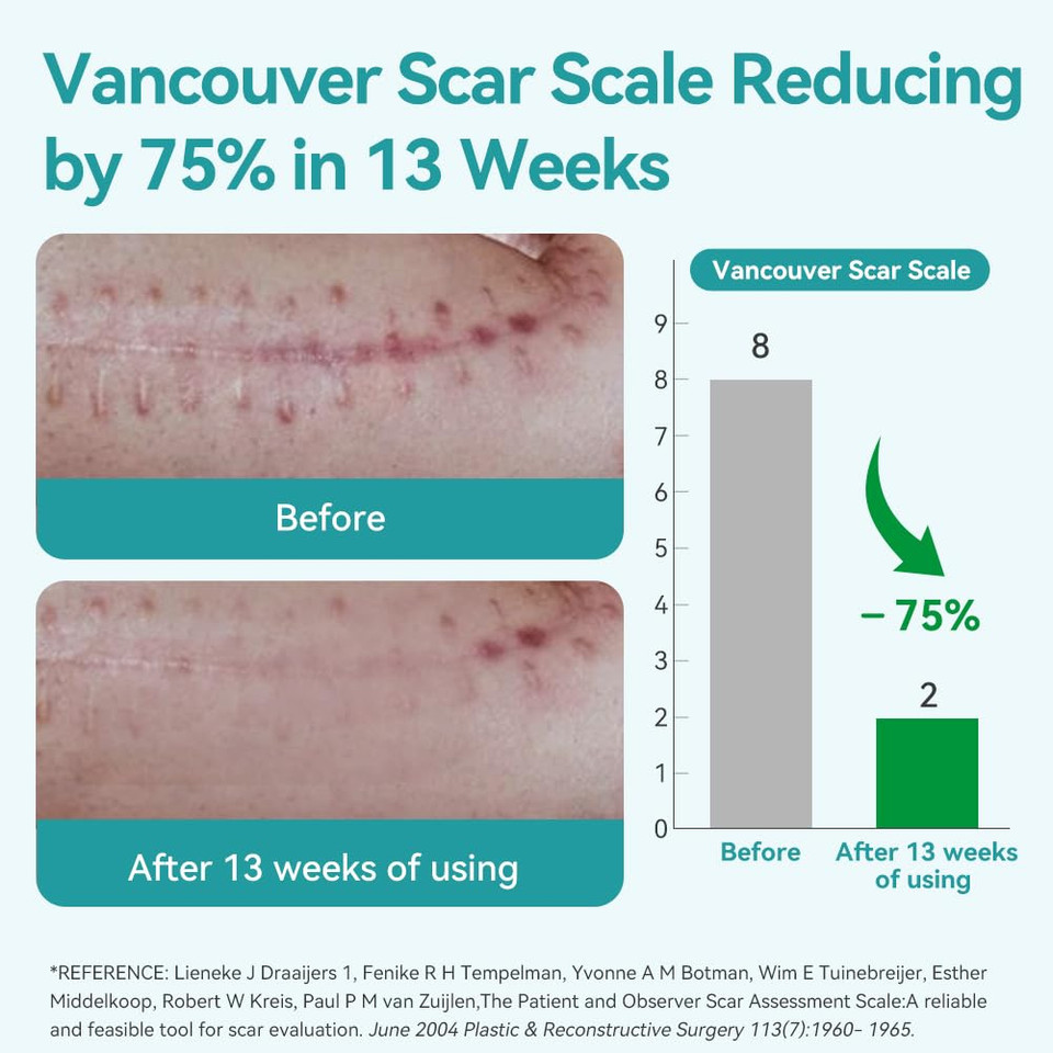 Dimora Waterproof Silicone Scar Sheets - Medical Grade Hypoallergenic Silicone Scar Tape (1.6X60" Roll), Ultra-Soft Scar Removal Treatment For Surgical Scars, C Section, Tummy Tuck, Keloid Treatment