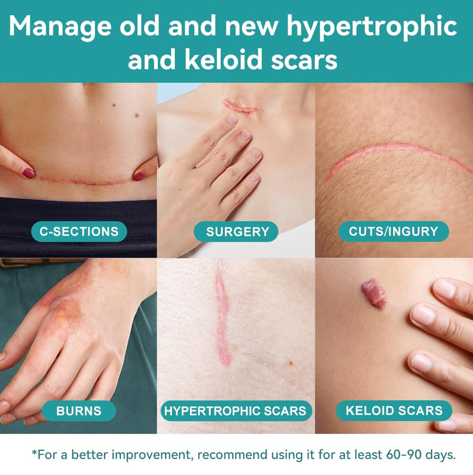 Dimora Waterproof Silicone Scar Sheets - Medical Grade Hypoallergenic Silicone Scar Tape (1.6X60" Roll), Ultra-Soft Scar Removal Treatment For Surgical Scars, C Section, Tummy Tuck, Keloid Treatment