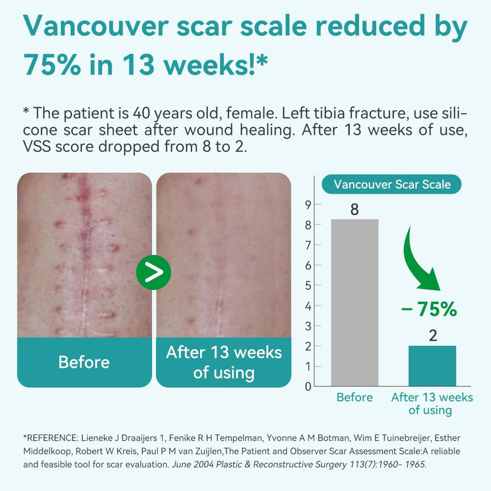 Dimora Waterproof Silicone Scar Sheets - Medical Grade Hypoallergenic Silicone Scar Tape (1.6X60" Roll), Ultra-Soft Scar Removal Treatment For Surgical Scars, C Section, Tummy Tuck, Keloid Treatment