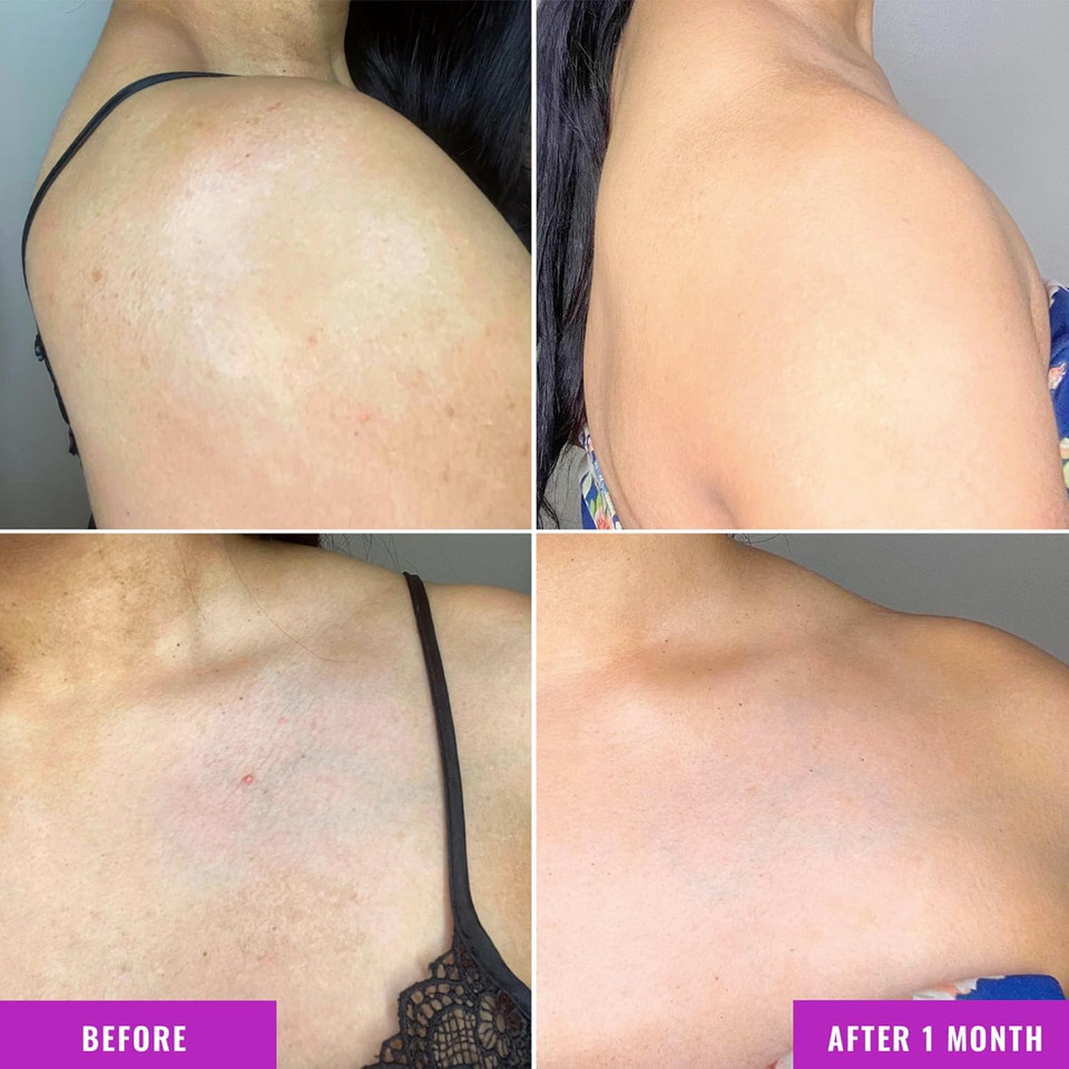 Good Molecules Discoloration Correcting Body Treatment - Anti-Pigment Cream With Niacinamide, Tranexamic Acid - Target Dark Spots And Moisturize - Skincare For Body