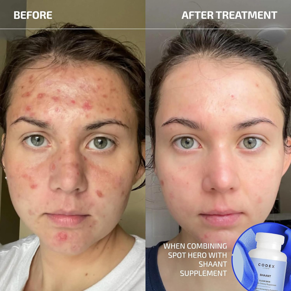 Codex Labs Shaant Spot Hero  Sulfur & Green Tea Gel For Blemish-Prone Skin | Fast-Drying Formula For Clear-Looking Skin | 0.5Oz