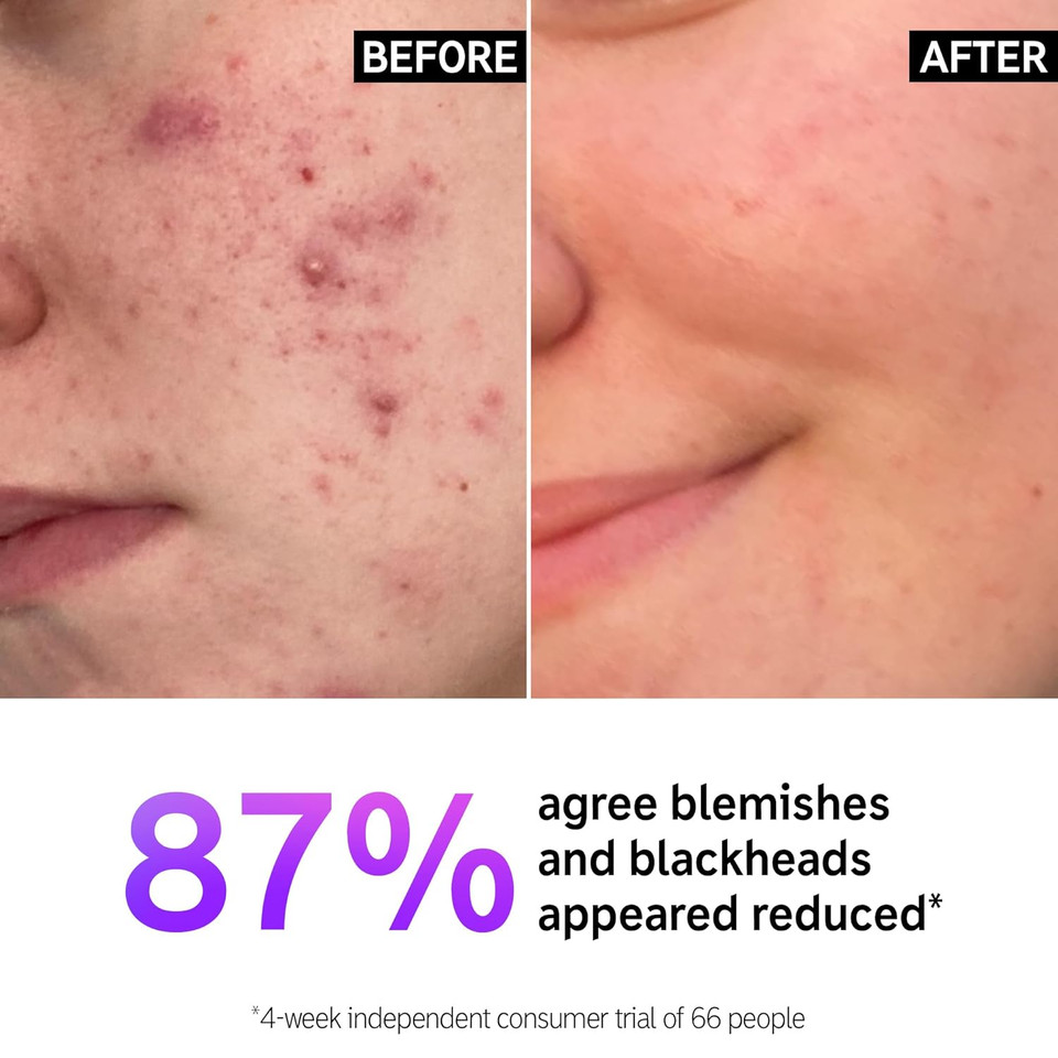 The Inkey List Salicylic Acid Cleanser, Face Wash For Blemishes, Blackheads, Oily Skin And Breakouts, Non-Drying Facial Cleanser Safe For All Skin Types, 5.0 Fl Oz