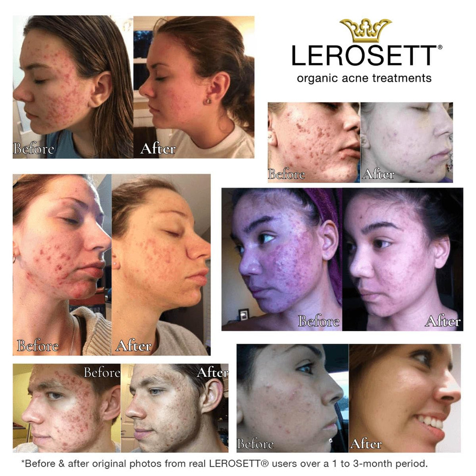 Lerosett Botanical Acne Cleanser, Foaming Gel Face Wash For Acne Prone, Vegan, Blackheads & Oily Skin 50% Calming Aloe, 2% Salicylic Acid, All Skin Types. Vegan - 6.7Oz 60-Day