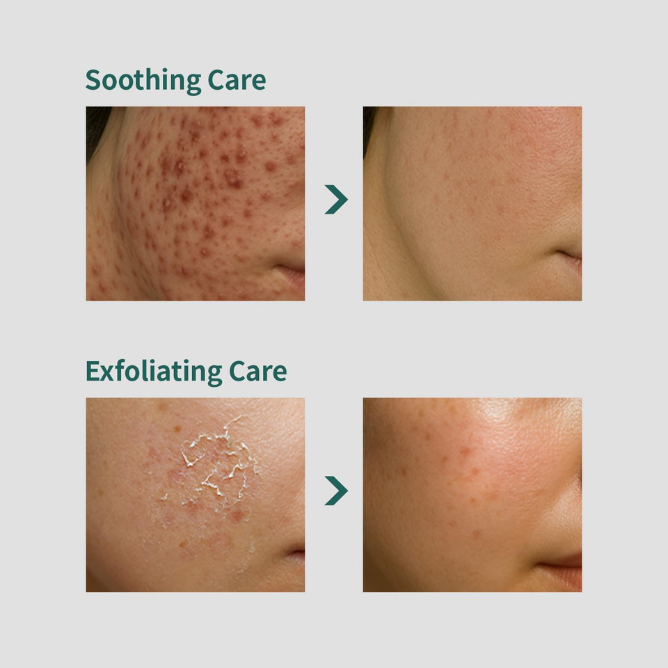 Coxir Aha + Bha Pore Clearing Toner L All Skin Types, Purifying, Aha, Bha, Daily Pore Care,K Beauty Skincare [150Ml,5.07Fl.Oz]