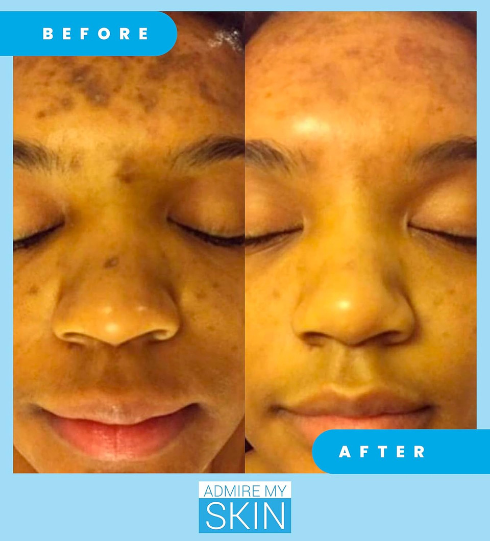 Admire My Skin Dark Spot Corrector Remover For Face - Brightening Discoloration Correcting Serum - Kojic Acid + Azelaic Acid Serum For Melasma And Sun Spots 1Oz