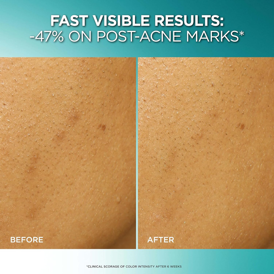 L'Oreal Paris Bright Reveal Dark Spot Exfoliant Peel, 25% Aha Bha Pha Face Exfoliator Solution, Gentle Skincare To Visibly Reduce Dark Spots And Renew Skin Texture, Includes Spf Lotion Sample