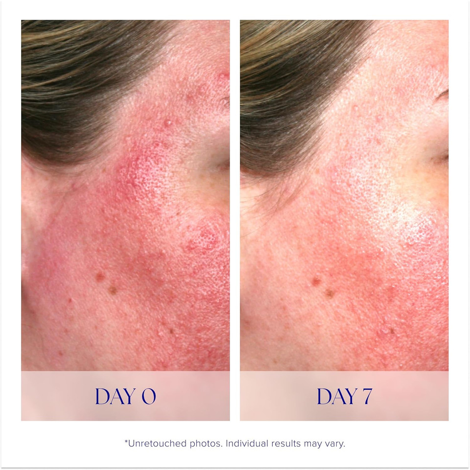 Is Clinical Pro-Heal Serum Advance+ - Antioxidant-Rich Vitamin C Serum, Calms Sensitivity & Irritation, Helps Redness, Anti-Aging