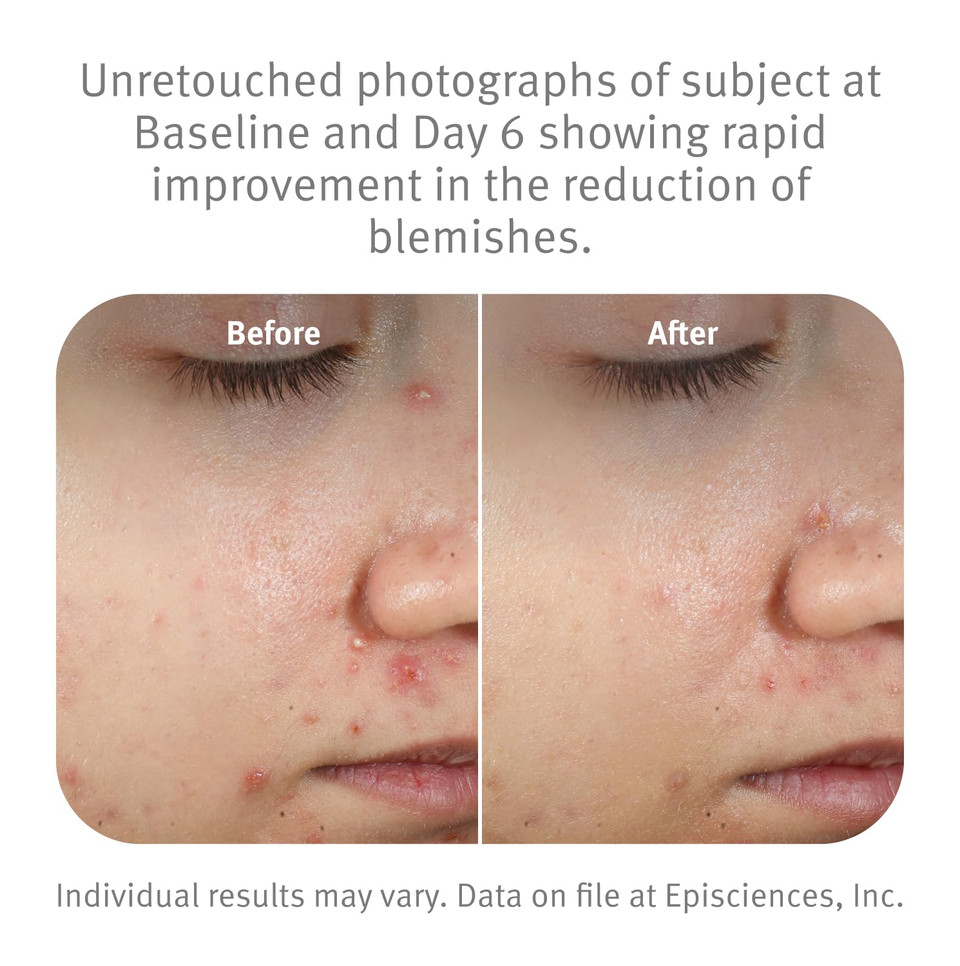 Epionce Purifying Spot Gel - Spot Gel For Oily & Problem Skin With Coconut Oil, Sulfur, Menthol & Azelaic Acid, Dermatologist Skincare