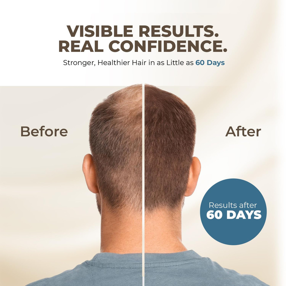 Hairmetto Saw Palmetto Extract Serum For Hair Loss, Hair Growth Serum With Stinging Nettle, Rosemary Oils And Peppermint Scent, Hair Serum For Men And Women - 4Oz (118Ml)