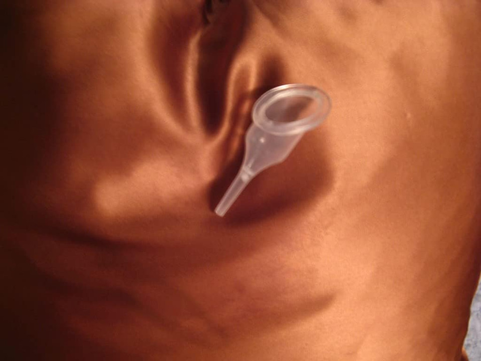 M Pain Management Technologies Nugyn Eros Therapy Caress Cups (Pkg. Of 5)