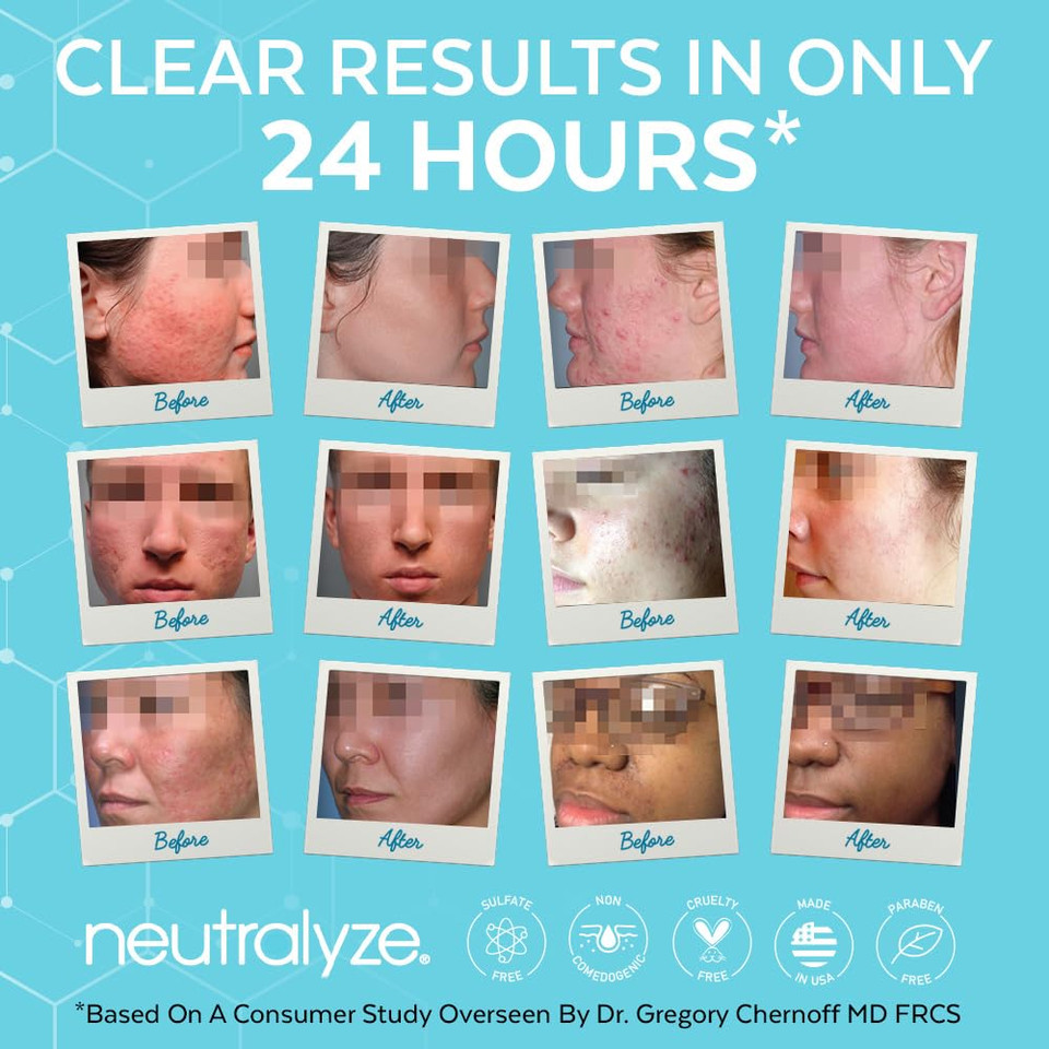 Moderate To Severe Acne Treatment Kit - Maximum Strength 3 Step System With 2% Salicylic Acid, 2% Mandelic Acid & Nitrogen Boost Skincare Technology - Acne Medication For Teens & Adults (90+ Day)