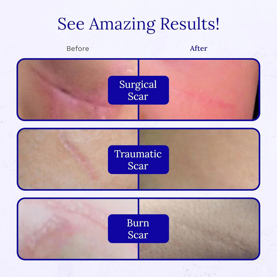 Rejuvaskin Rejuvasil Silicone Scar Gel, Scar Treatment For Surgical Scars, Burns, Keloids, Acne Scars On Face & Body, 0.33 Ounce