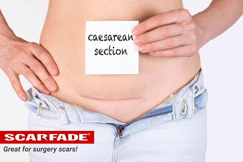 Vitamin C Scar Cream- Face & Body Scars, 0.5 Oz