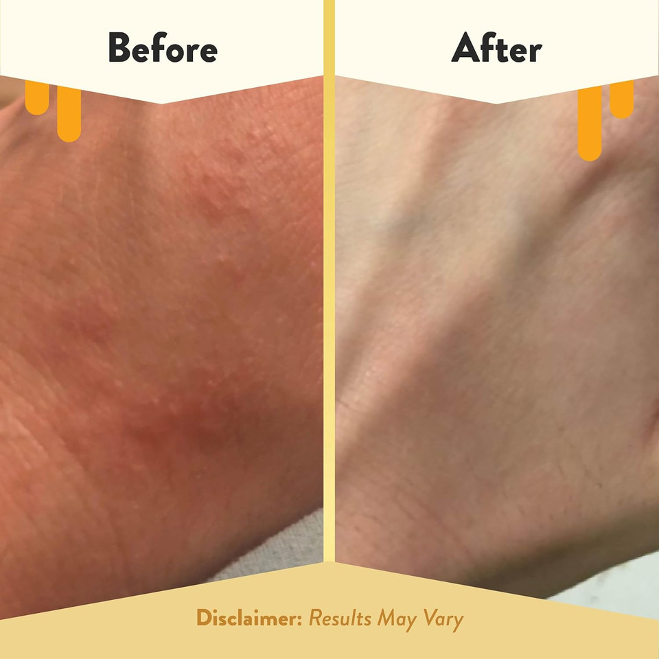 Eczema Honey Oatmeal Body Lotion - Hand & Body Cream For Eczema Relief - Natural Dry Skin Repair (16 Oz)