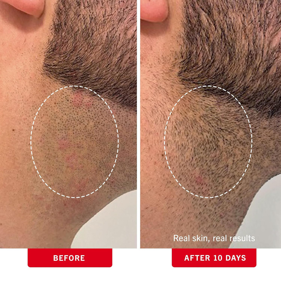 First Aid Beauty - Ingrown Hair Pads With Bha + Aha - Aftershave Treatment Pads To Help Prevent Razor Bumps For Men & Women - Exfoliate Underarms & Bikini Area - Compostable For Daily Use - 60 Pads