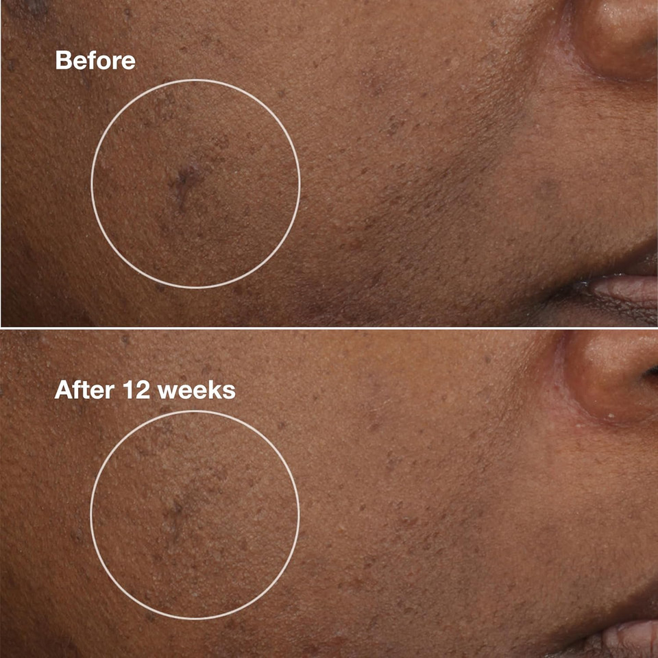 Clinique Even Better Clinical Brightening Moisturizer With Salicylic Acid, Glucosamine + Vitamin C | Hydrating + Dark Spot Reducing