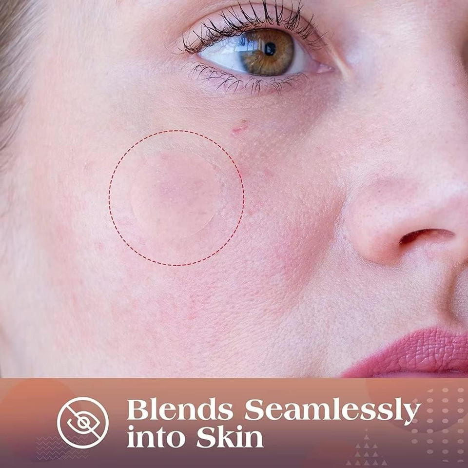 Auslka Blemishes Patches -175 Patches - Hydrocolloid Spot Dots - Blemishes Patch - Pimple Stickers, For Face Absorbing Cover Patch Auslka Blemishes Patches -175 Patches - Hydrocolloid Spot Dots - Blemishes Patch - Pimple Stickers, For Face Absorbing Cover Patch