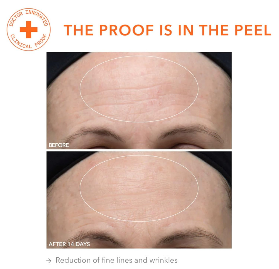 Dr. Dennis Gross Alpha Beta Ultra Gentle Daily Peel: For Dehydrated Or Sensitive Skin, Uneven Tone Or Texture, Fine Lines Or Enlarged Pores (5 Treatments)