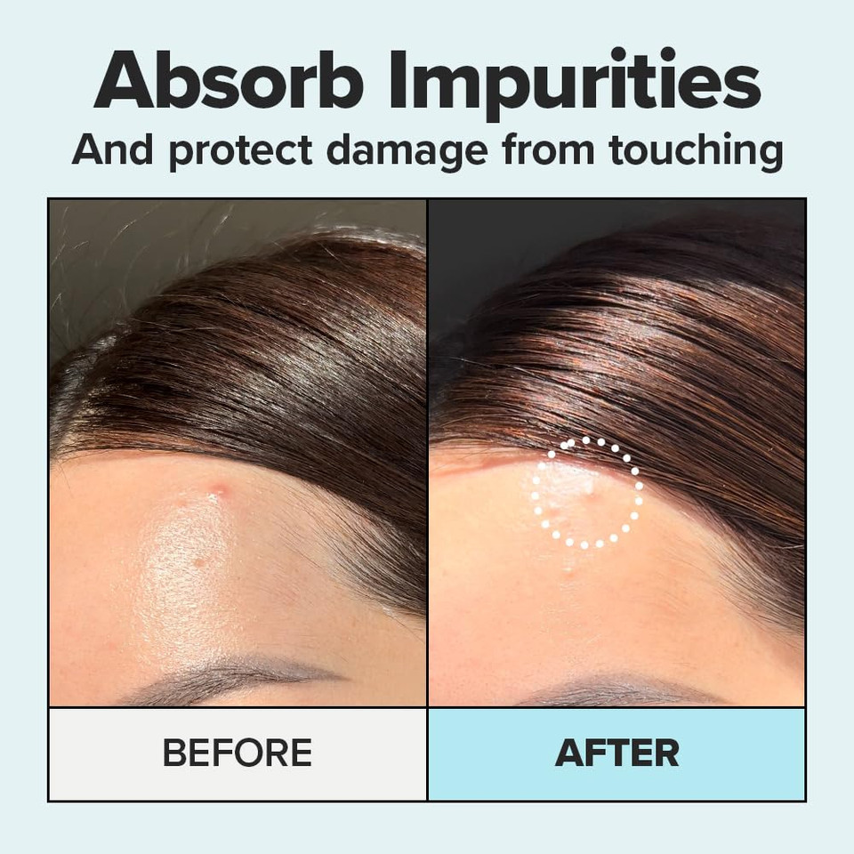 I Dew Care Hydrocolloid Acne Pimple Patch - Timeout Blemish Dark Spot | Korean Zit Patches For Face And Skin, Facial Stickers, Pus Absorbing With Tea Tree Leaf Oil, 32 Count