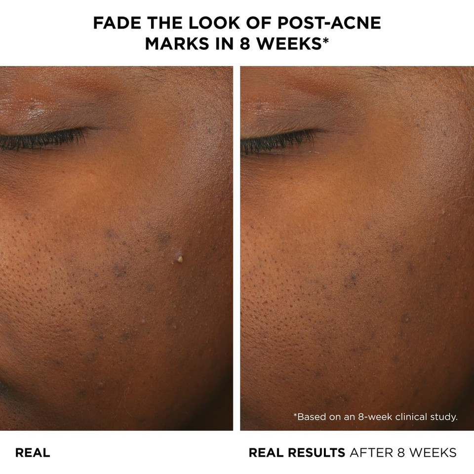 It Cosmetics Bye Bye Breakout Acne Treatment Face Serum -With 2% Salicylic Acid & 3% Lactic Acid - Helps Reduce Pimples In 3 Days & Fades Look Of Post-Acne Marks In 8 Weeks - 1 Fl. Oz