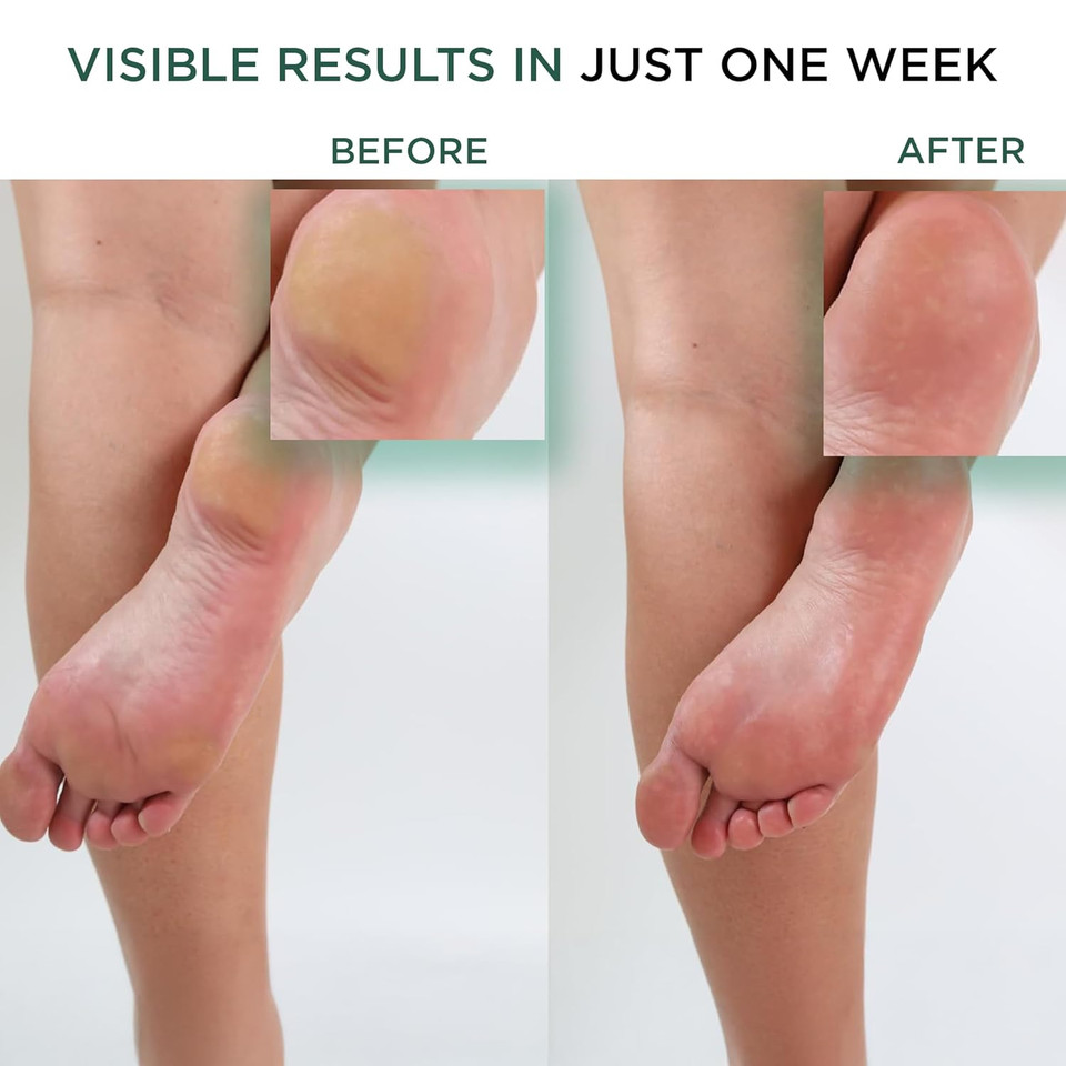 Hey Honey Walk The Walk Propolis Foot & Heel Cream For Dry, Cracked Feet | 72-Hour Hydration, Callus Remover & Odor-Fighting Moisturizer With Honey & Urea | 5 Oz