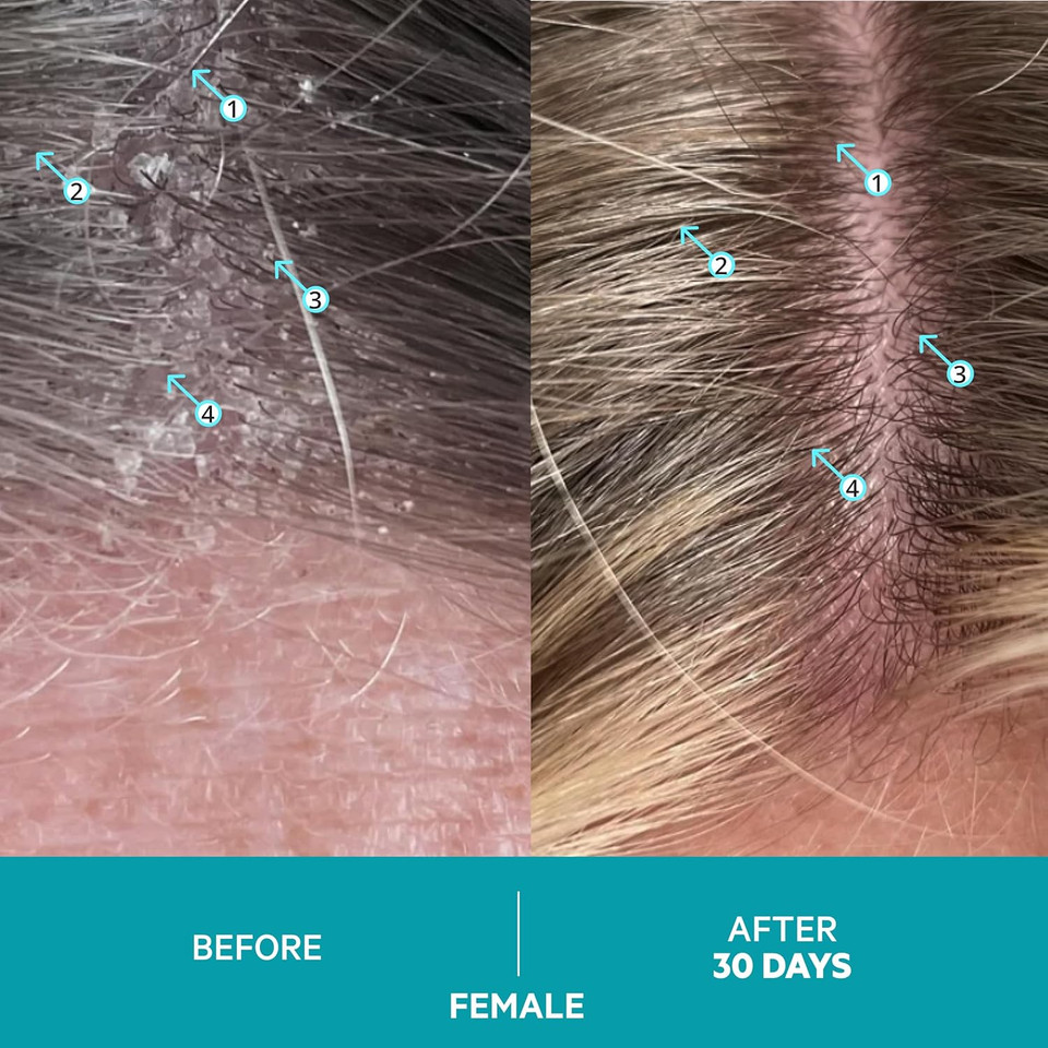 Ds Labs Dandrene Anti Dandruff Shampoo And Conditioner - Itchy & Dry Scalp Dandruff Treatment Shampoo Conditioner Set, Seborrheic Dermatitis Dandruff Scalp Treatment, Psoriasis Scalp Treatment