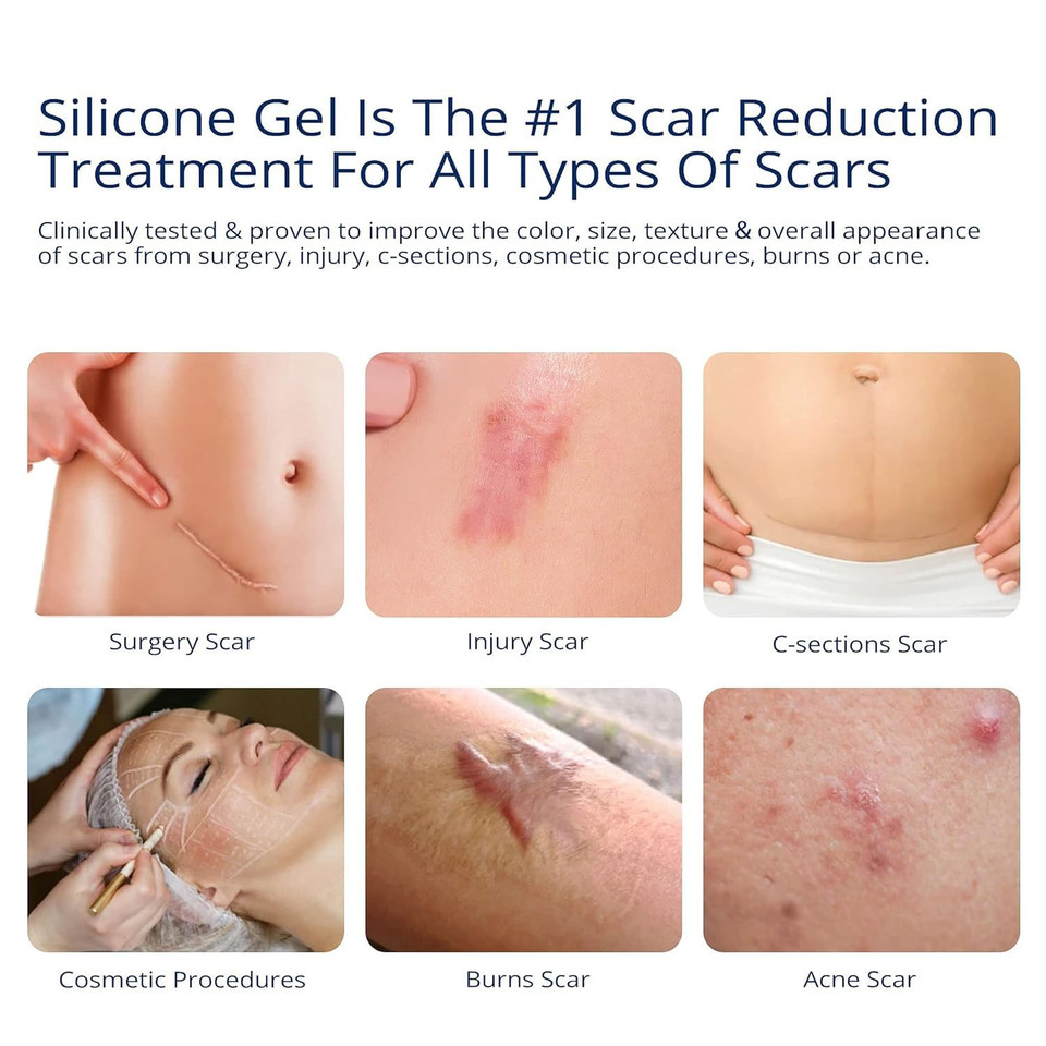 100% Silicone Scar Gel Scar Cream - Advanced Scar Gel For Surgical Scars, C-Section, Stretch Marks, Acne, Injury, Burns, Keloids, Old And New Scars 1.06Oz(30G) (Maximum Strength 100% Silicone)