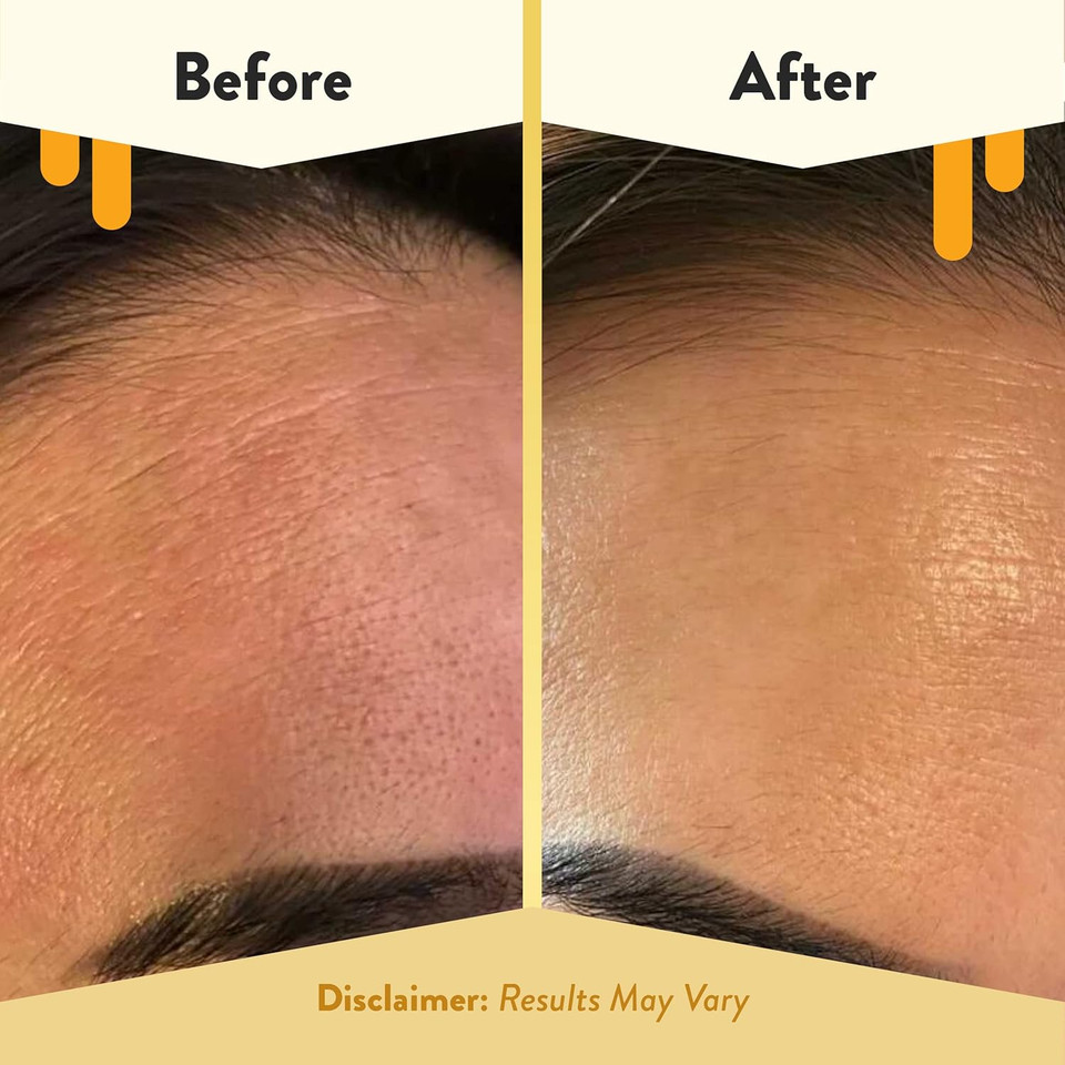 Eczema Honey 15% Vitamin C + Ferulic Acid Serum - Anti Aging Skin Care Products - Face Oil For Eczema, Dry & Sensitive Skin (1 Oz)