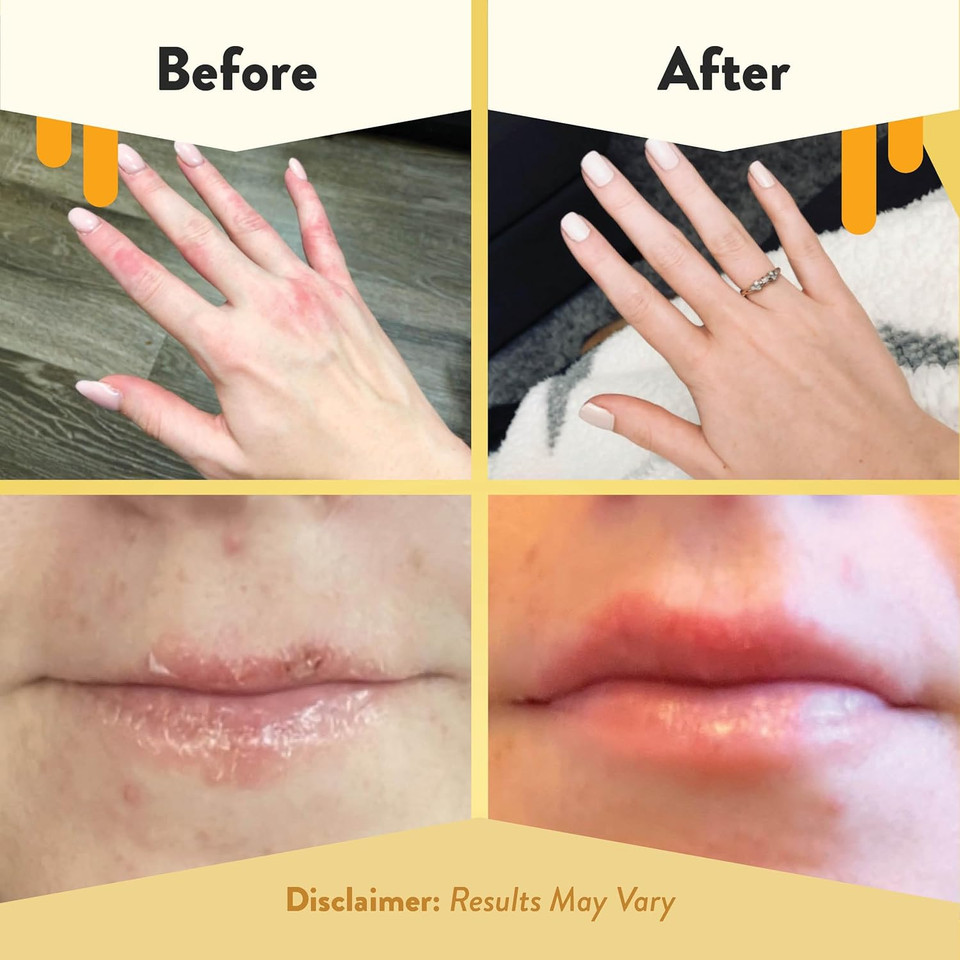 Eczema Honey Survival Kit - Skin Soothing Cream, Body Lotion, Hand Cream, & Lip Balm - Natural Eczema Treatment For Sensitive Skin - Itch Relief For Psoriasis, Dermatitis & More