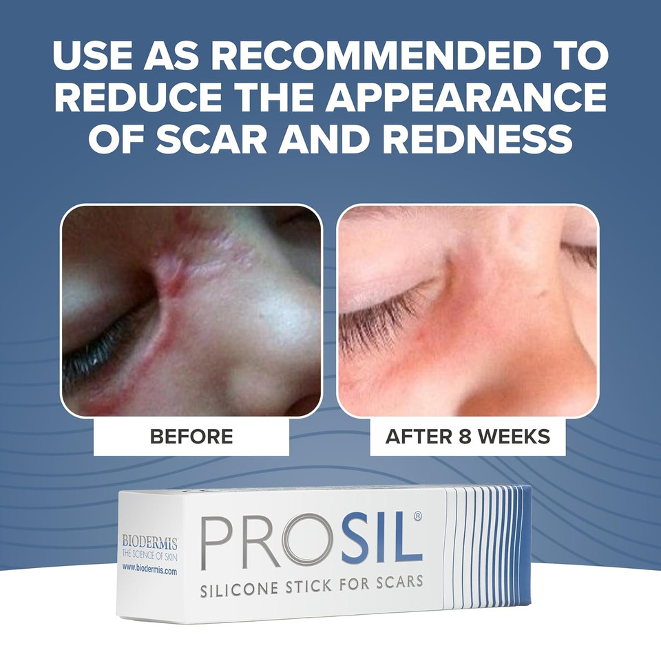 Prosil Silicone Scar Stick 4.25G  Effective Scar Treatment With Premium-Grade Scar Silicone  Compact, Mess-Free, Glide-On Application For Convenient Scar Therapy  Gentle On All Skin Types & Kids
