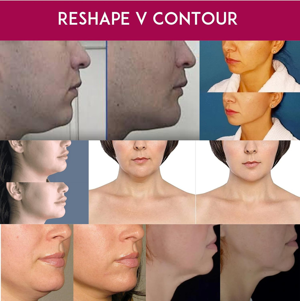 Anacis - Double Chin Reducer - Neck Loose Sagging Skin Lifting Tightening Firming Face Shaping. Vela Contour (Cream)