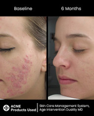 Acne: Beneath the surface