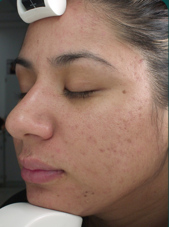Duality acne result after 5 months