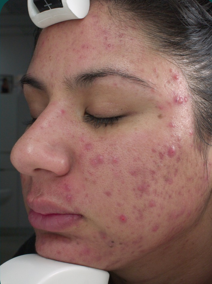 Duality acne baseline
