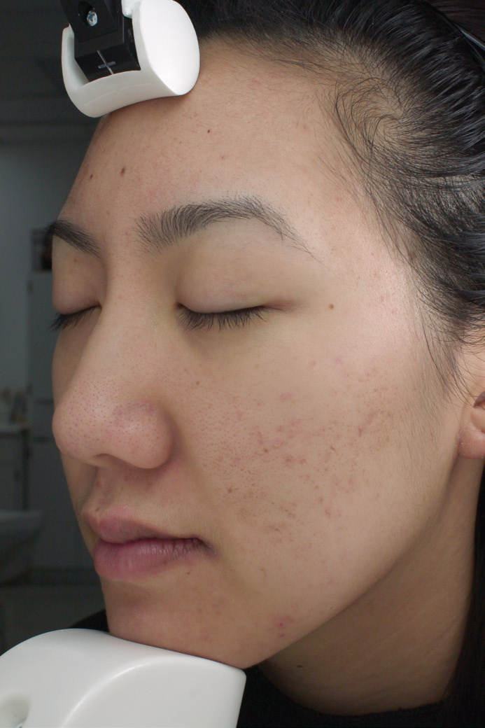 Duality acne result after 12 months