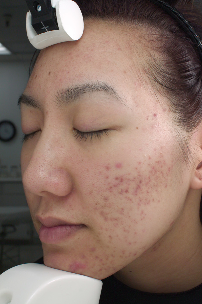 Duality acne baseline